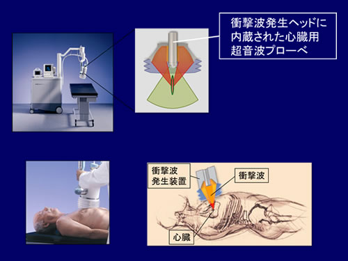 図１：心臓用低出力体外衝撃波治療装置
