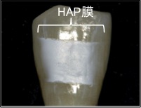図3：HAP膜による歯の色調改善