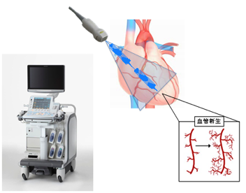 特殊な条件の超音波を心臓に照射すると、虚血領域の心筋で血管新生が促進される。