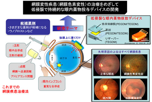図1：網膜変性疾患（網膜色素変性）の治療をめざして低侵襲で持続的な眼内薬物投与デバイスの開発