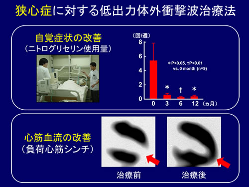 図２：狭心症に対する低出力体外衝撃波治療