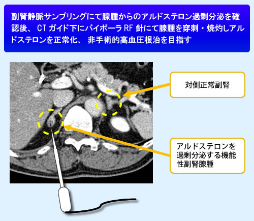 図3：原発性アルドステロン症RF治療の概念