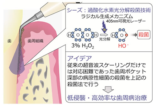 図1：ラジカル殺菌歯周治療器のコンセプト