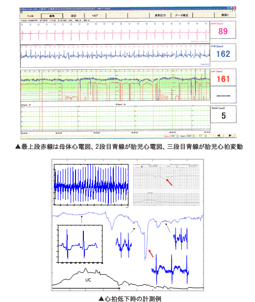 図3：胎児心電図の計測画面と計測例